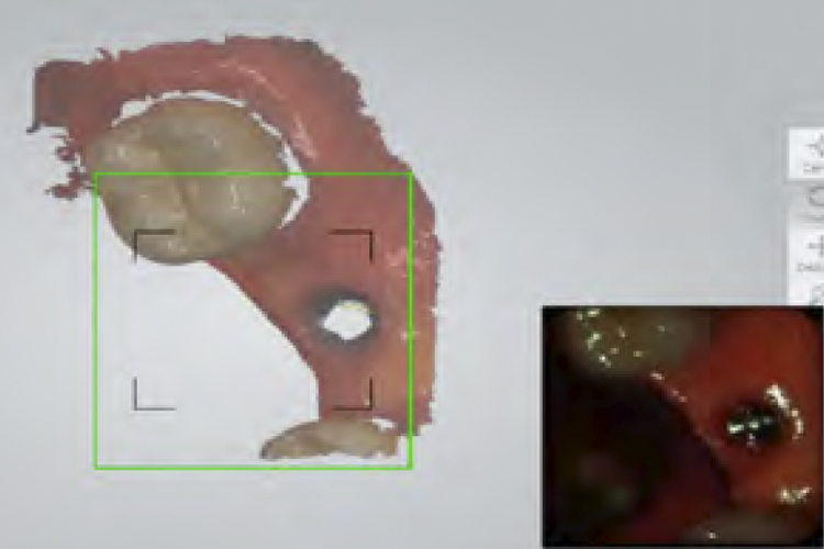 empreinte optique iphysio implantologie 2