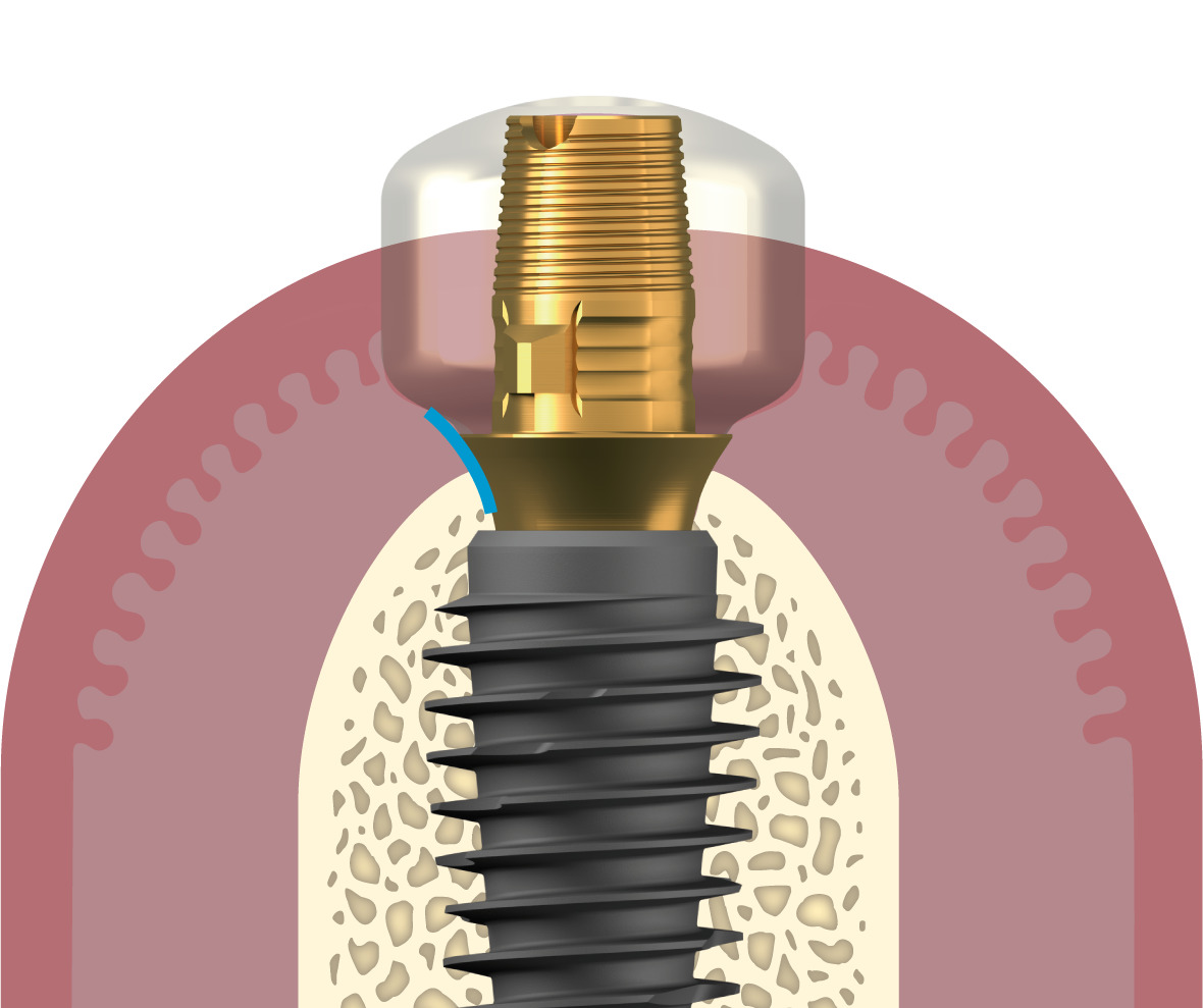 gencive iphysio esthetibase