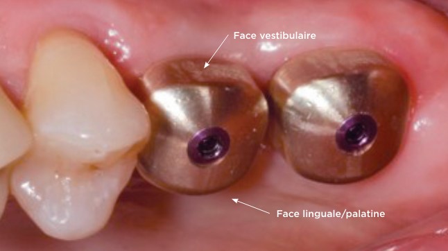 préserver papille gingivale iphysio oui